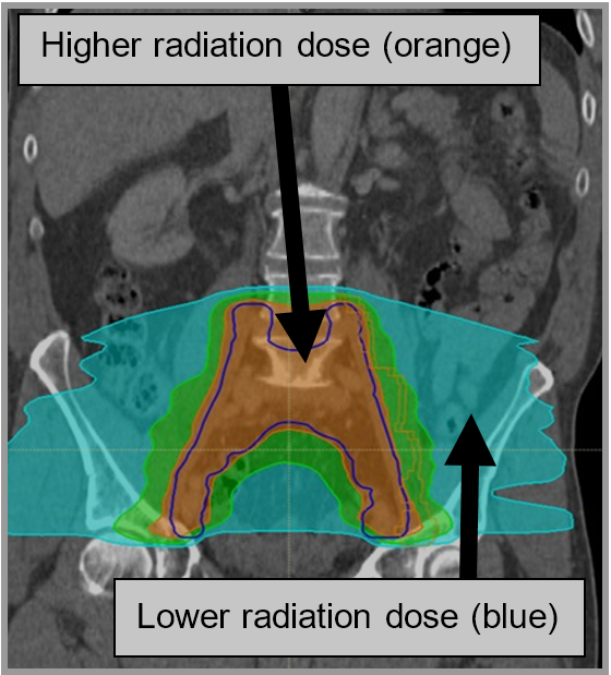 X-ray image showing a large treatment area where the highest radiation dose is in the centre of the treatment area, steadily decreasing to the the edges.