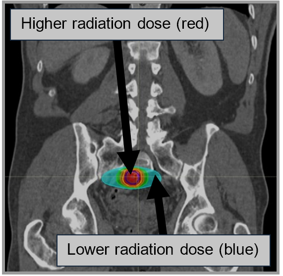 X-ray image showing a small, focused treatment area where the highest radiation dose is in the centre of the treatment area, steadily decreasing to the the edges.